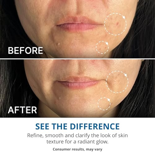 Gopure Refine It 2% Bha Liquid Exfoliant Ãƒ¢Ã¢Š¬Ã¢‚¬Å“ Pore Refining Texture Smoothing Complexion Correcting Infused With Nourishing Fruit Extracts Safe For All Skin Types