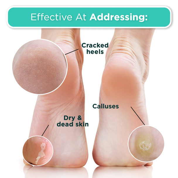 DERMORA Foot Peel Mask | Skin Exfoliating Foot Masks | Dry Cracked Feet Callus Dead Skin Remover | Baby Soft Feet Tea Tree Scent | Pack of 2 | Regular