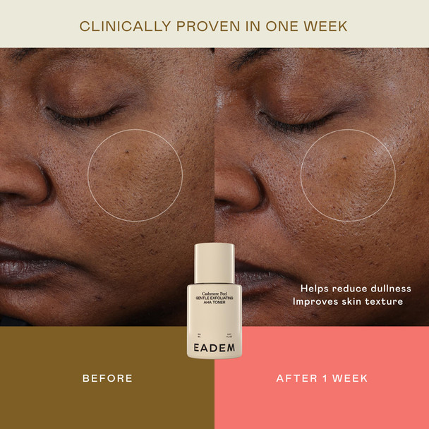 EADEM Gentle Exfoliating AHA & PHA Toner Exfoliating Face Serum with Tranexamic Acid AHA Exfoliant & Pore Minimizer for Face and Body Acne Spot Serum 5.0 oz Cashmere Peel