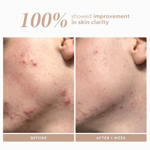 SHANI DARDEN Rescue Serum with 10% Azelaic Complex Lightweight Hydrating Azelaic Acid Serum for Face with Oat Kernel & Aloe Extracts Helps Skin Redness & Acne Non-Comedogenic Vegan 1 fl oz