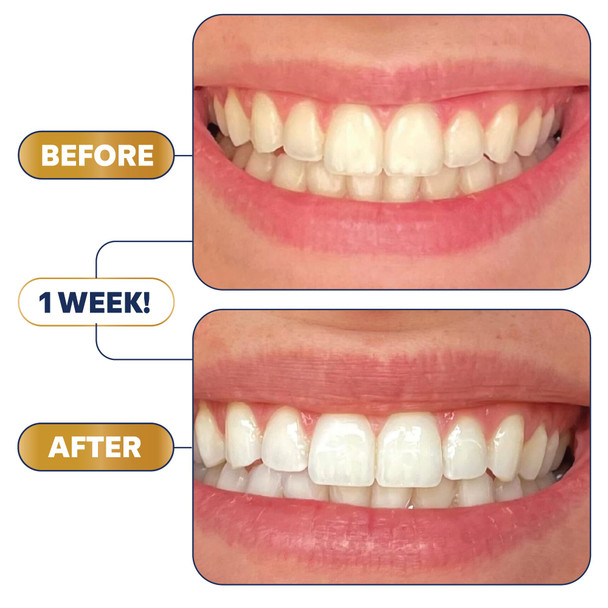 Lumineux Teeth Whitening Strips Kit - 9 Treatments (1 Month) - Peroxide Free - Enamel Safe for Whiter Teeth - Whitening Without The Sensitivity - Dentist Formulated - Sensitivity Free