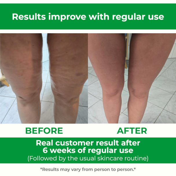 TESMED Cellulite Manual Massager : Made in Italy Patented with Converging & Diverging Roller Technology. Anti Cellulite Roller for Thighs and Buttock