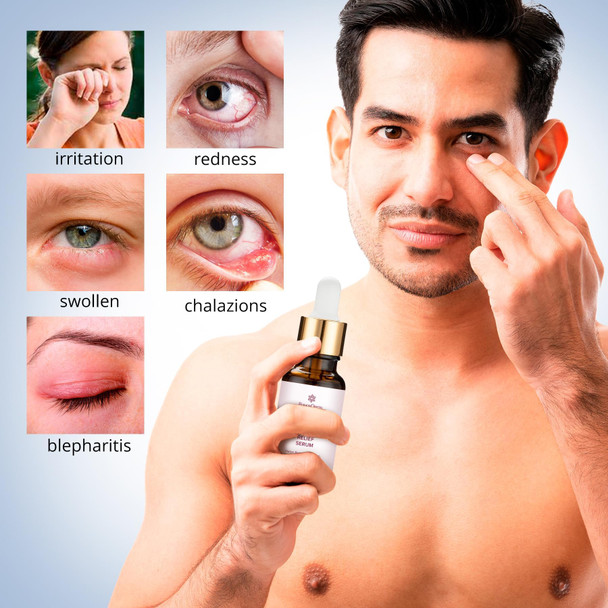 Roycederm Stye Eye Treatment Serum: Natural Stye Remover for Styes Chalazion and Blepharitis - Safe & Fast Relief (0.68 Fl Oz (Pack of 1))