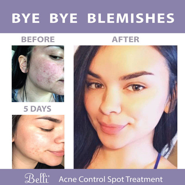 Belli Skincare Acne Control Spot Treatment - Skin Care Treatment - Acne Treatment - Vegan Face Wash - Pregnancy Acne Treatment - Acne Spot Treatment for Face - Face Care