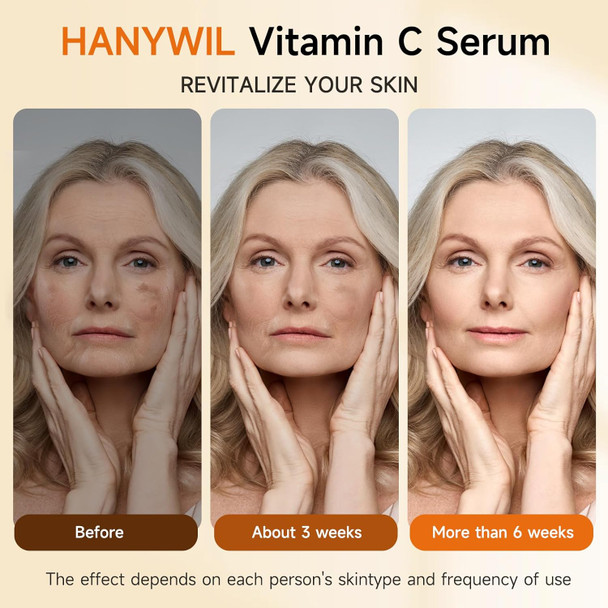 Hanywil 20% Super Vitamin C Serum For Mature Skin Targets Age Spot & Wrinkle Reduction With Hyaluronic Acid Hydrating Anti-Age Serum 1.7Fl Oz
