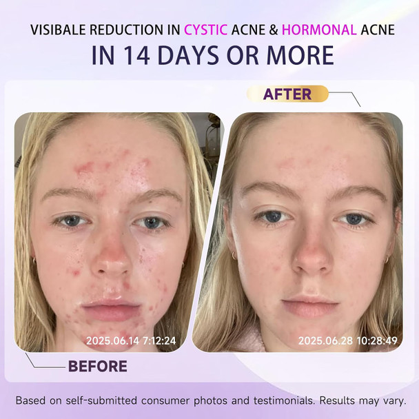 Kempc Cystic Acne Treatment For Face Hormonal Acne Spot Treatment Pimple Cream With Azelaic Acid | Redness Reducing Acne Moisturizer For Rosacea & Sensitive Acne-Prone Skin | Teens & Adults 1.7 Oz