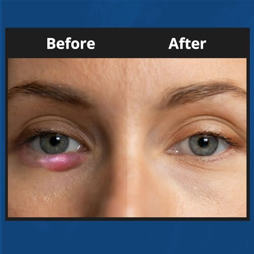 Noveha Xstye Eyelid Foaming Cleanser - Fast Stye Eye Relief - Formula With Tea Tree Oil - Daily Eyelid And Eyelash Wash For Stye Eyes Eyelash & Skin Dryness (3.38 Fl Oz) - 100Ml