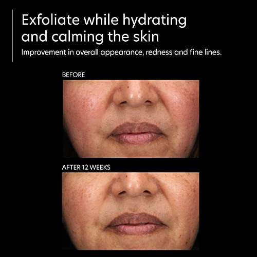 Pca Skin Resurfacing Serum - Gentle Exfoliating Facial Corrective With Lactic & Glycolic Acid For Bright Even Skin (1 Fl Oz)