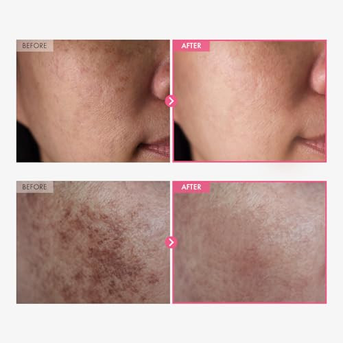 Tosowoong Txa Glow & Care Duo: Arbutin 7 Tranexamic Acid 4 Cream And Txa+Niacinamide 10 Tranexamic Acid 4 Serum For Uneven Skin Tone And Texture | Korean Skincare