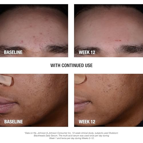 Neutrogena Stubborn Blackheads Daily Acne Facial Serum With Salicylic Glycolic Polyhydroxy & Mandelic Acids Oil-Free Face Serum For Acne-Prone Skin To Help Clear Clogged Pores 1 Fl. Oz