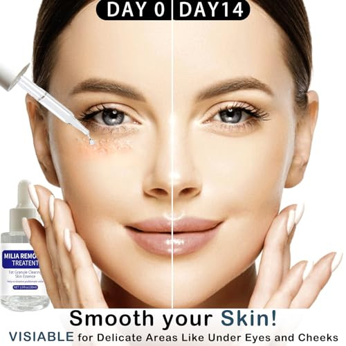 Dermfree Milia Remover Treatment Milia Spot Treatment With Salicylic Acid Milia Acne Serum Clearing Skin Essence(30Ml)