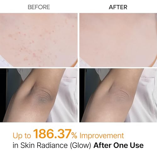 Dr.Melaxin Body Keratin Care Kojic Acid Turmeric Spray With Aha & Pha Gentle Body Brightening & Exfoliating Peeling Solution For Dead Skin Cells & Texture Korean Skincare 6.76 Fl.Oz