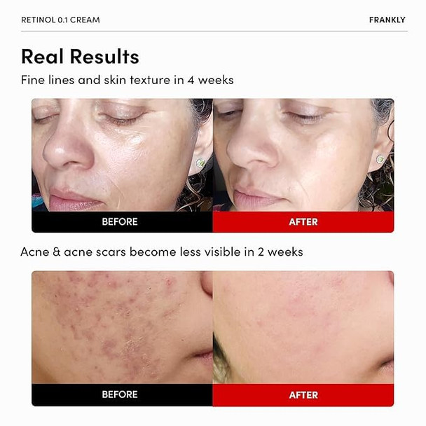 Frankly Rejuvenating Duo For Mature Skin Retinol 0.1% Cream & Salmon Dna Pdrn Serum Deep Repair & Firming Korean Skincare Mothers Day Gitts For Women