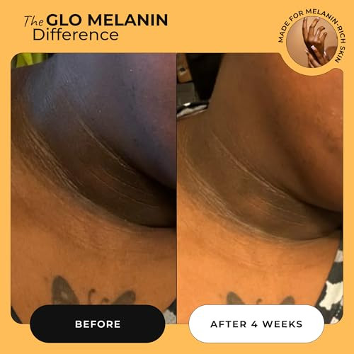 Glo Melanin Magic Eraser Dark Spot Cream For Face Body & Sensitive Areas - Inner Thighs Remover Made In Usa - Faded Cream For Black Spots 1.7 Oz