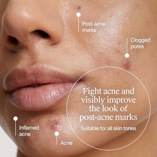 Neutrogena Evenly Clear Retinoid Adapalene Gel 0.1% Acne Spot Treatment Once-Daily Topical Retinoid Helps Clear Breakouts & Visible Improvement In The Appearance Of Post-Acne Mark 0.5 Oz