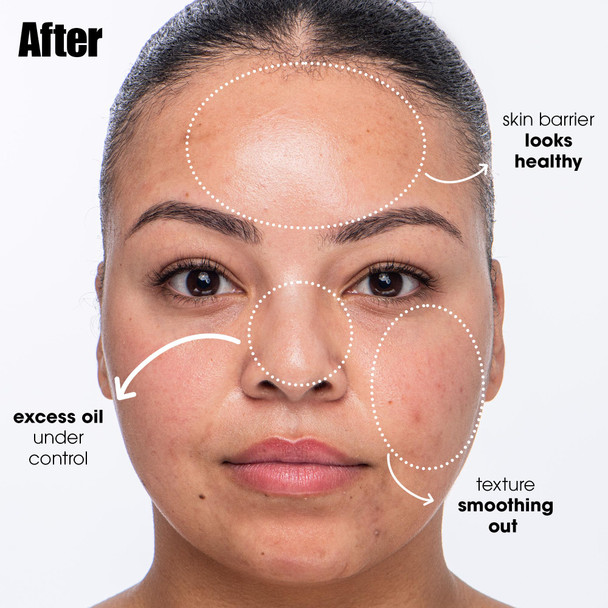Sunday Riley Breakout Breakup Salicylic Acid Cleanser For Blemish-Prone Skin