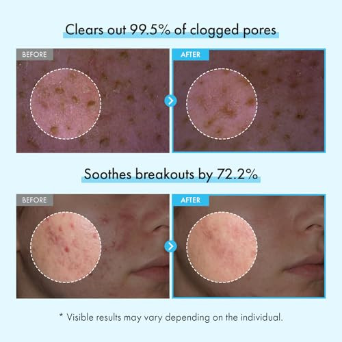Tosowoong Azelaic Acid Niacinamide Face Wash 99% Purity Azelaic Acid Mochi Whip Cleanser With Capsules Excess Sebum Centella Asiatica For Acne-Prone Skin Korean Skincare 100Ml / 3.38 Fl. Oz