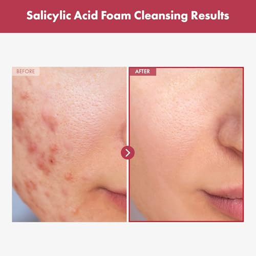 Tosowoong Salicylic Acid Foam Cleanser For Oily Skin 18000Ppm Salicylic Acid Deep Pore Cleansing Face Wash For Breakouts Exfoliating Cleanser Korean Skin Care 100Ml 3.38 Fl. Oz