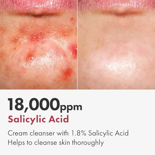 Tosowoong Salicylic Acid Foam Cleanser For Oily Skin 18000Ppm Salicylic Acid Deep Pore Cleansing Face Wash For Breakouts Exfoliating Cleanser Korean Skin Care 100Ml 3.38 Fl. Oz