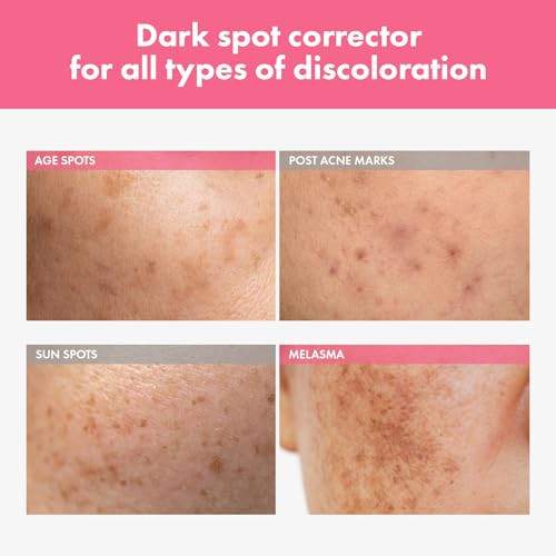 Tosowoong Arbutin 7% Intensive Spot Cream With 70000Ppm Arbutin 3% Tranexamic Acid 1% Niacinamide Glutathione Dark Spots Freckle Blemishes Anti-Pigmentation Korean Skin Care 20Ml 0.67 Fl.Oz