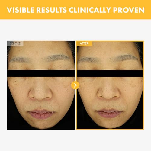Tosowoong 8 Days Spot Cream Dark Spot Remover For Face Age Spot Sun Spot Freckles Melasma Brown Spot Serum Advanced Formula Corrector Cream With Niacinamide For Women And Men 50G 1.76 Oz