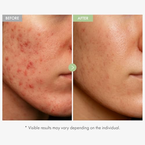 Tosowoong Exosome Cica Face Cream - Daily Soothing Moisturizer For Breakouts And Irritated Skin Fast-Acting Lightweight Korean Skincare For Redness And Blemish-Prone Skin 50Ml / 1.69 Fl. Oz
