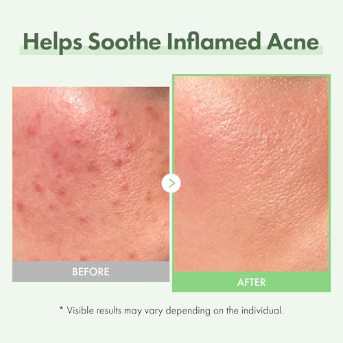 Tosowoong Azelaic Acid 10% Face Serum Rosacea Care Redness Soothing And Blemish Centella Asiatica For Acne-Prone Niacinamide Hyaluronic Acid Korean Skincare Natural Color 33 Ml / 1.11 Fl. Oz