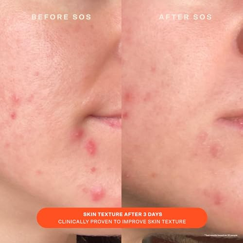 Tower 28 Sos Skin Care Set - Facial Spray (1 Oz) + Barrier Recovery Cream (1.86 Oz) - Hypochlorous Acid Spray To Calm Irritation + Redness + Hydrating Face Moisturizer With Hyaluronic Acid (2 Count)