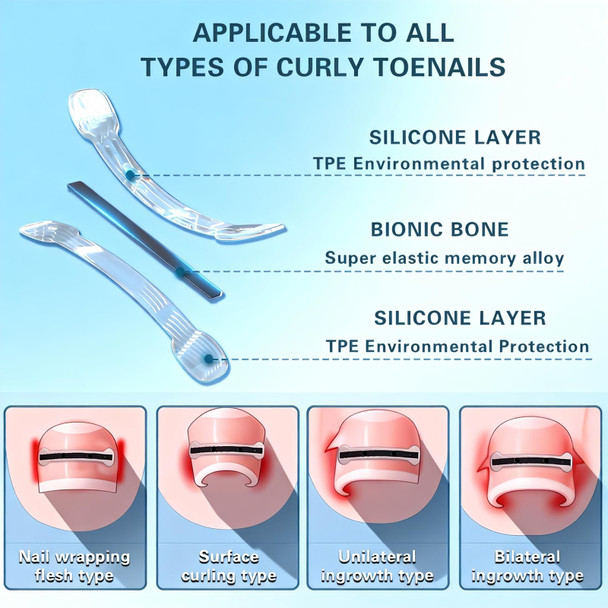 Yin Aawaeao Titanium Alloy Ingrown Toenail Treatment - Professional Home Care For Curved Nails - Waterproof Nail Tools And Ingrown Toenail Removal KitIngrown Toenail Corrector(0.59/0.67In)