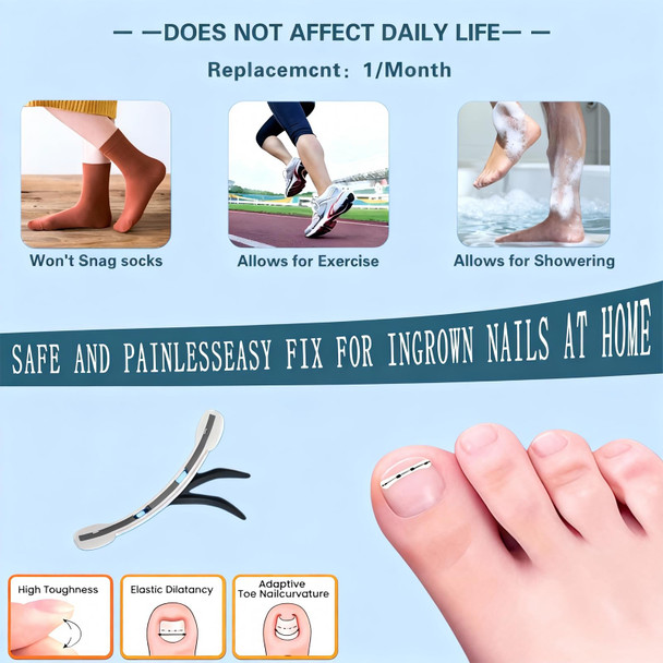 Yin Aawaeao Titanium Alloy Ingrown Toenail Treatment - Professional Home Care For Curved Nails - Waterproof Nail Tools And Ingrown Toenail Removal KitIngrown Toenail Corrector(0.59/0.67In)