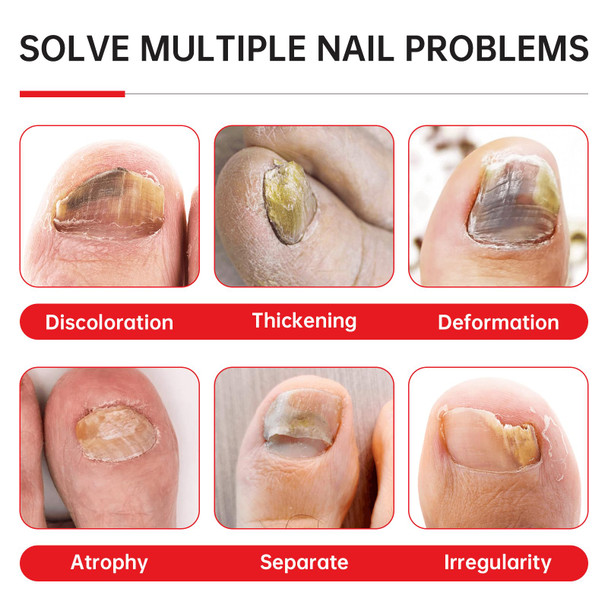 Qqe Nail Fungus Treatment Extra Strength - 25 Undecylenic Acid Gentle Plant Formula For Fingernails Treats Under & Around Nail Treatment Discoloration Repair Thick Damaged Nails 2.02Fl.Oz