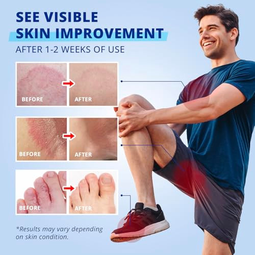 Tagrid Antifungal Jock Itch Cream Jock Itch Relief For Men And Women - Extra Strength Antifungal Cream For Skin - Anti Fungal Itchy Skin Relief - Relieves Itching Burning Cracking Scaling 2.02 Oz