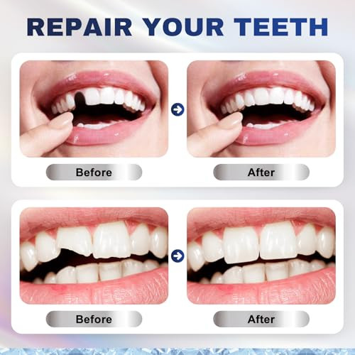 Walejuc Tooth Repair Kit Moldable Beads For Instant Teeth Fix & Confidence Boost (1 Count (Pack Of 1))