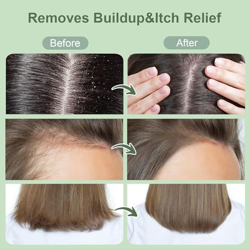 Zengyqi Scalp Scrub, Rosemary & Mint Oil & Biotin Scalp Exfoliator Scrub Shampoo With Silicone Cleansing Massager, Hair Treatment For Itchy Scalp, Dandruff & Buildup Removal & Thick And Strong Hair Growth