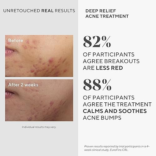 Murad Deep Relief Acne Spot Treat With 2 Salicylic Acid Patch-Like Liquid Treat For Deep Hormonal Acne & Breakouts 1 Fl Oz