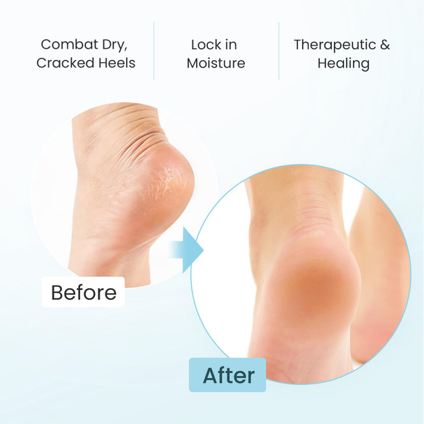 Welnove Moisturizing Heel Socks For Cracked Feet Foot Care Moisture Toeless Socks Heel ProtectorsBlue 2 Pairs