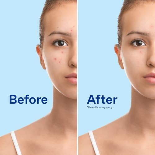 Differin Acne Face Wash with 10% Benzoyl Peroxide, Maximum Strength OTC Acne Foaming Cleanser, Fast Acting Acne Treatment for Face and Body, 5 oz.