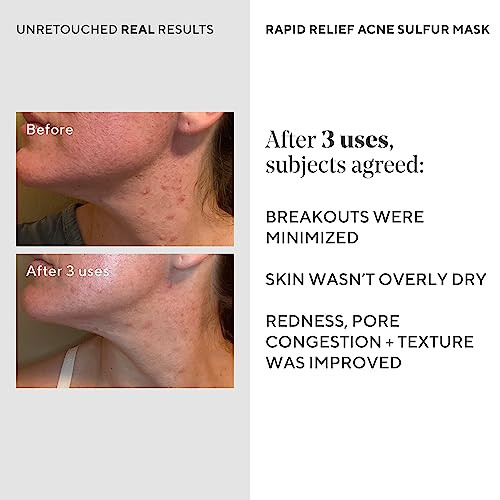 Murad Rapid Relief Acne Sulfur Mask Clay Mask With Salicylic Acid 5% 2.5 Fl Oz