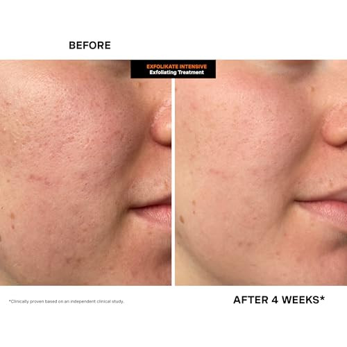 Kate Somerville Exfolikate Intensive Exfoliating Treatment Salicylic Acid And Lactic Acid Super Facial 0.5 Fl Oz