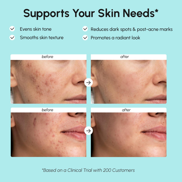 Maree Azelaic Acid Face Cream Azelaic Acid Treatment With Niacinamide and Salicylic