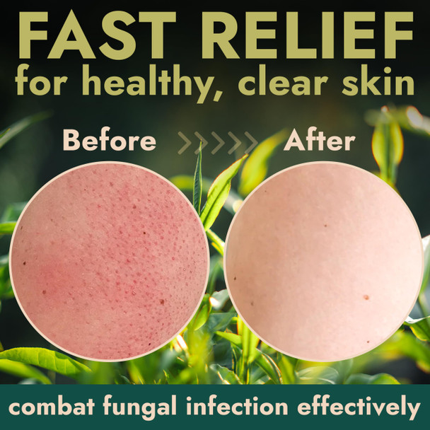 Terramed Just Think Comfort Antifungal With Tea Tree Oil Exfoliating Body Wash For 12 Fl Oz