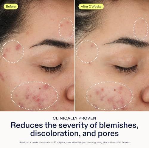 Skinfix  BHA Cleanser  Clears Acne Blemishes and Blackheads  Safe for All Types of Acne  Fragrance Free  Vegan Cruelty Free