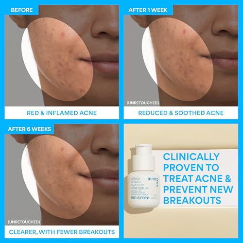 Innisfree Gentle Retinol Salicylic Acne Serumkorean Face Treatment With Niacinamide And Ceramides For Blemishes And Clear Skin