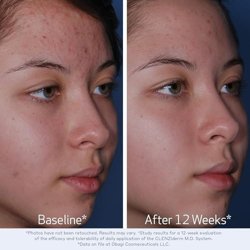 Obagi Medical CLENZIderm M.D. Pore Therapy Acne Treatment