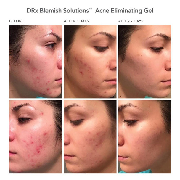 Dr Dennis Gross DRx Blemish Solutions Acne Eliminating Gel: for Frequent Breakouts, Congestion, Bumpy Texture & Oily Skin, 1.0 fl oz