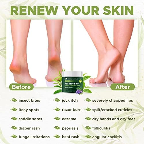 Owell Naturals Tea Tree Antifungal Balm – Extra Strength for Athlete’s Foot Jock Itch Ringworm and Skin Fungus  Soothing for Itchy Dry Cracked Skin Feet and Body