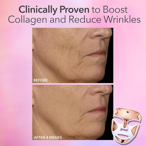 Dr. Dennis Gross DRx SpectraLite Dpl FaceWare Pro: Smooths Full Face Fine Lines and Wrinkles, Firms Skin, Prevents Acne Flare-Ups, and Reduces Redness and Irritation (White)