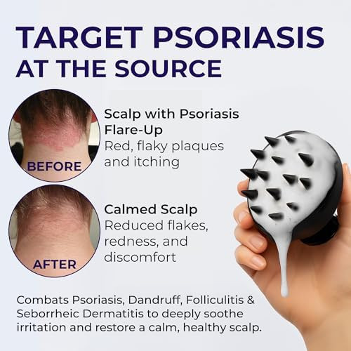 Pharmlitalia Psoriasis Shampoo Anti Dandruff Medicated shampoo for Dandruff Flakes Seborrheic Dermatitis & Folliculitis Treatment
