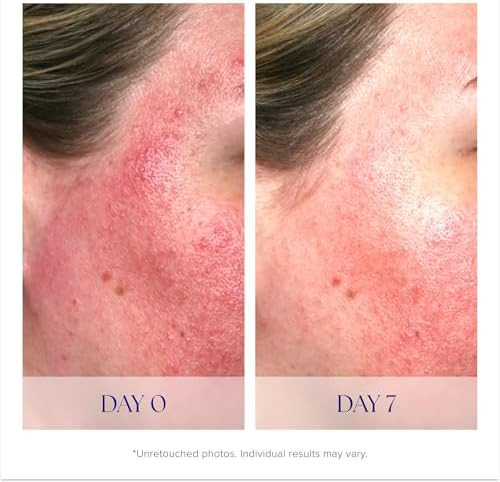 iS CLINICAL Pro Heal Serum Advance Antioxidant Rich Vitamin C Serum Calms Sensitivity & Irritation Helps Redness Anti Aging