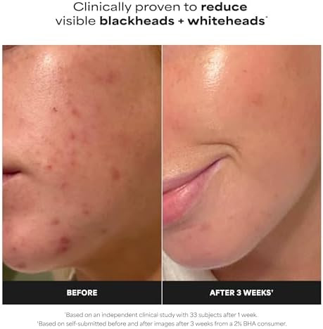 Paula's Choice SKIN PERFECTING 2% BHA Liquid Exfoliant
